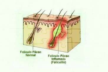 foliculite jigsaw puzzle