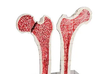 osteoporose jigsaw puzzle