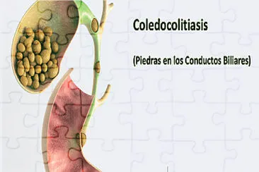 פאזל של Coledocolitiasis