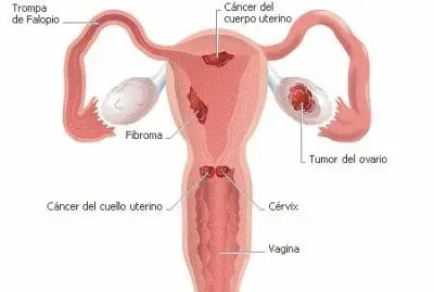 cancer