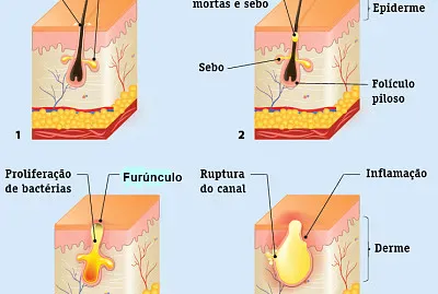 Furunculo
