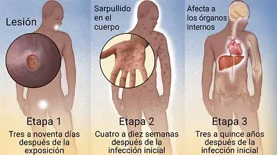 פאזל של SÃFILIS