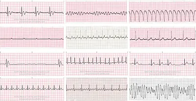 Ritmos electrocardiograficos jigsaw puzzle