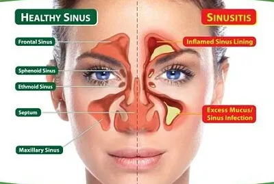 sinusitis