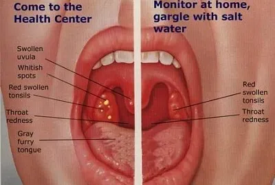faringitis jigsaw puzzle
