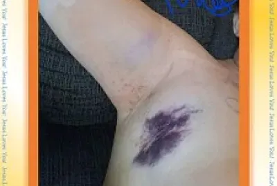 1st BREAST CANCER SURGERY, 3 Lymph nodes,7/20 1of3