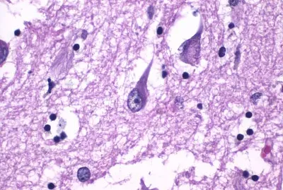 Histopathology of Neurofibrillary Tangles