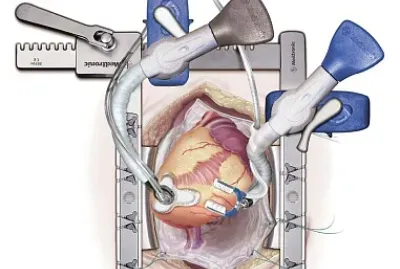 octopus tissue stabilizer
