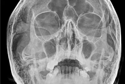 Radiografia de SPN jigsaw puzzle