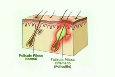 foliculite jigsaw puzzle