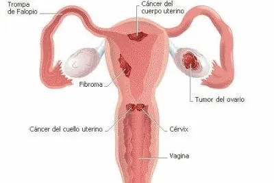 cancer