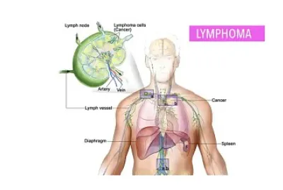 Lymphoma