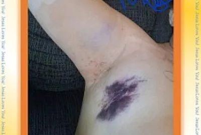 1st BREAST CANCER SURGERY, 3 Lymph nodes,7/20 1of3