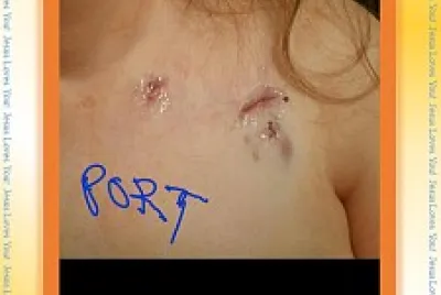 1st BREAST CANCER SURGERY, CHEMO PORT,7/20 2of3