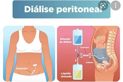 Diálise jigsaw puzzle