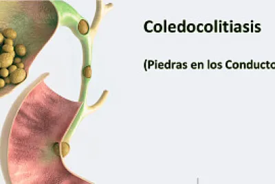 Coledocolitiasis