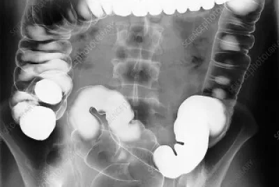Estudio de Colon por Enema Baritado jigsaw puzzle