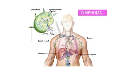 פאזל של Lymphoma