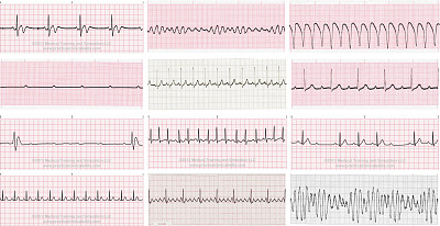 פאזל של Ritmos electrocardiograficos