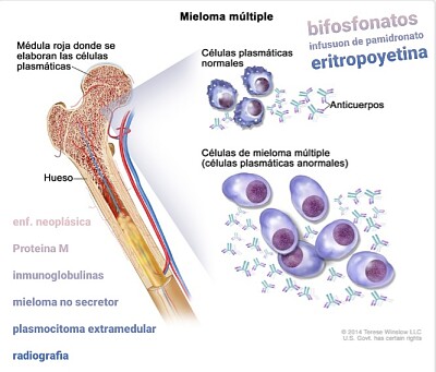 Mieloma Multiple