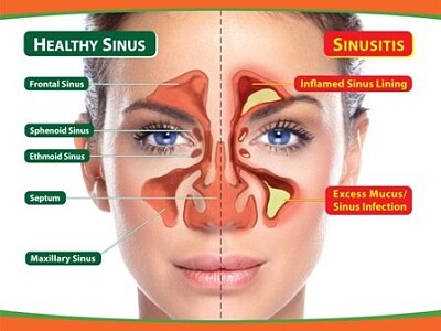 פאזל של sinusitis