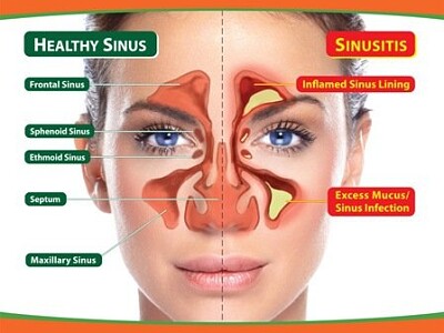 sinusitis