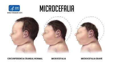 פאזל של Microcefalia.