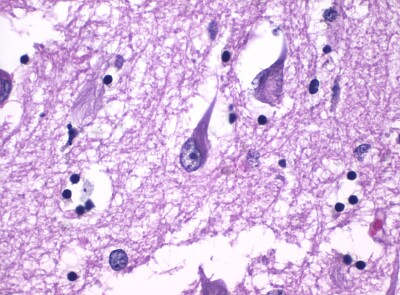 פאזל של Histopathology of Neurofibrillary Tangles