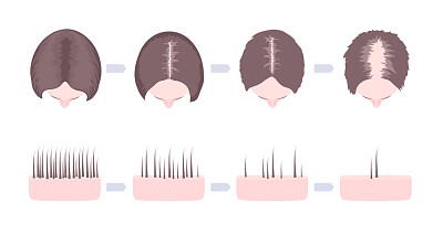 פאזל של Alopecia agenesica