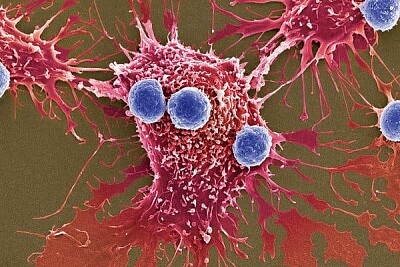 macrofago come neoplasia