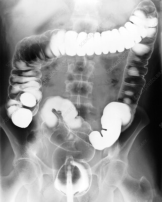 Estudio de Colon por Enema Baritado