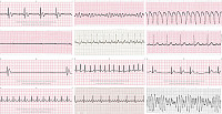 Ritmos electrocardiograficos